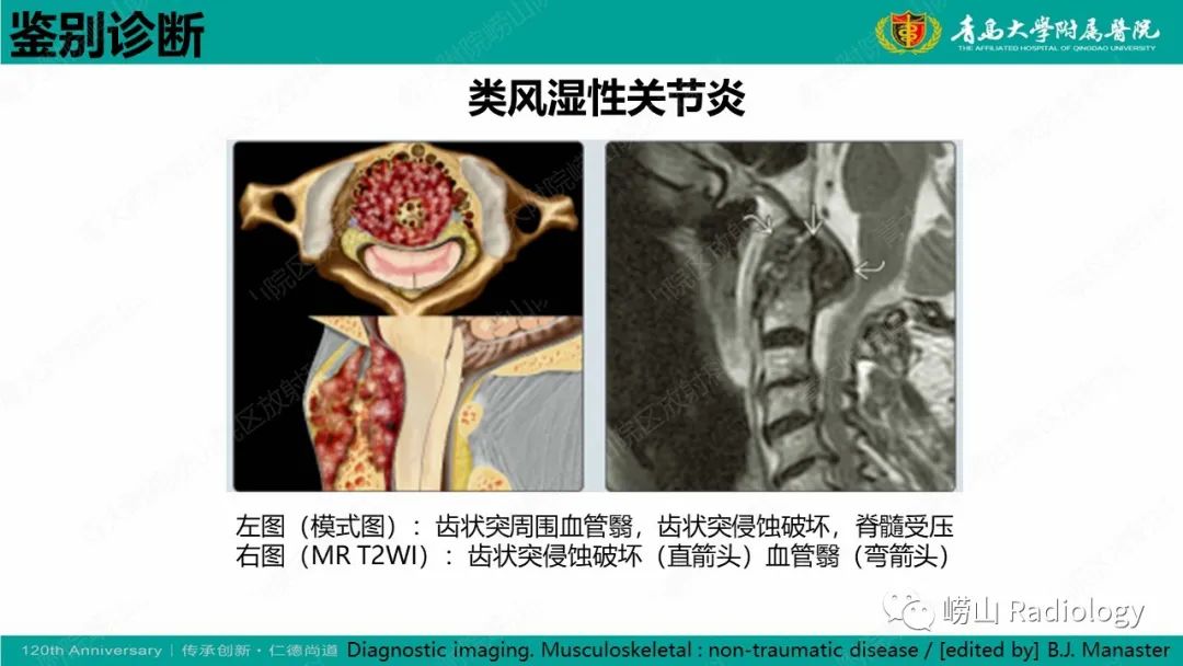 影像PPT - 【病例】弥漫性特发性骨肥厚症 VS 强直性脊柱炎-30