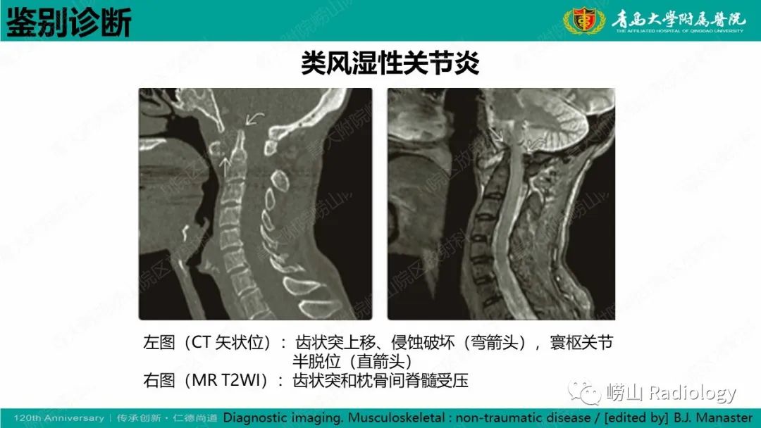 影像PPT - 【病例】弥漫性特发性骨肥厚症 VS 强直性脊柱炎-31