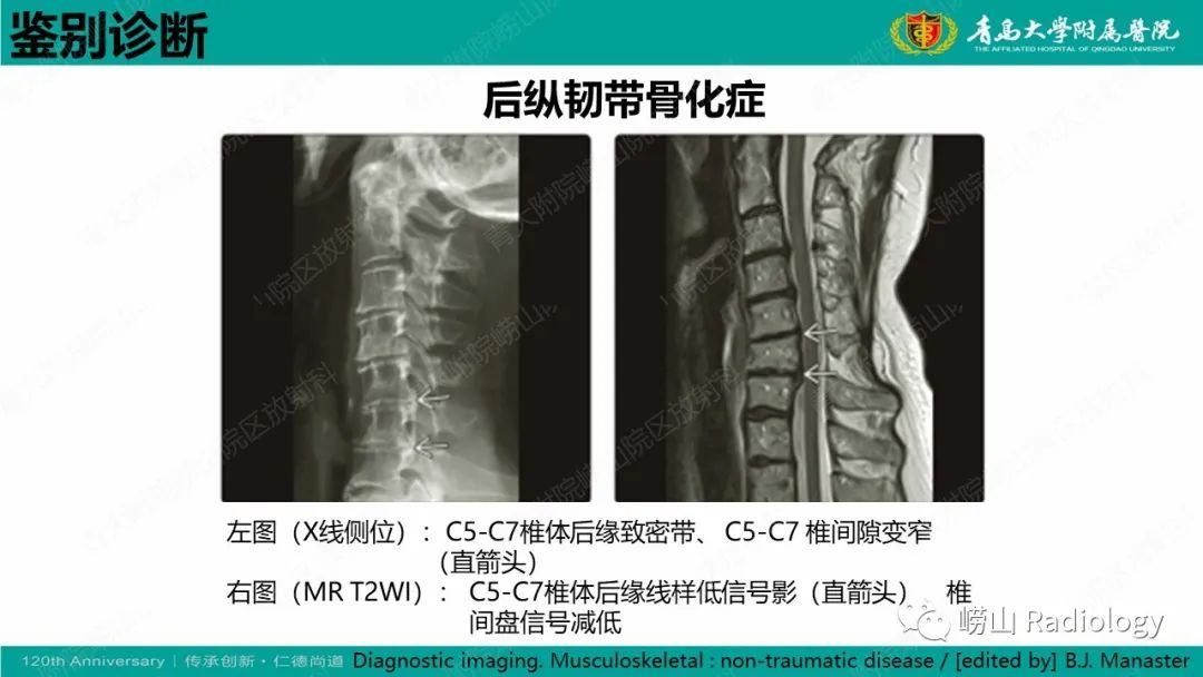 影像PPT - 【病例】弥漫性特发性骨肥厚症 VS 强直性脊柱炎-36