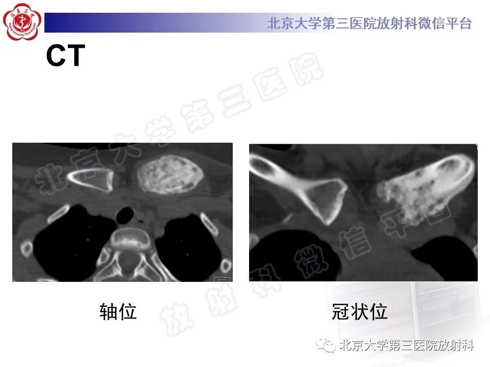 影像PPT - 【PPT】慢性复发性多灶性骨髓炎-4