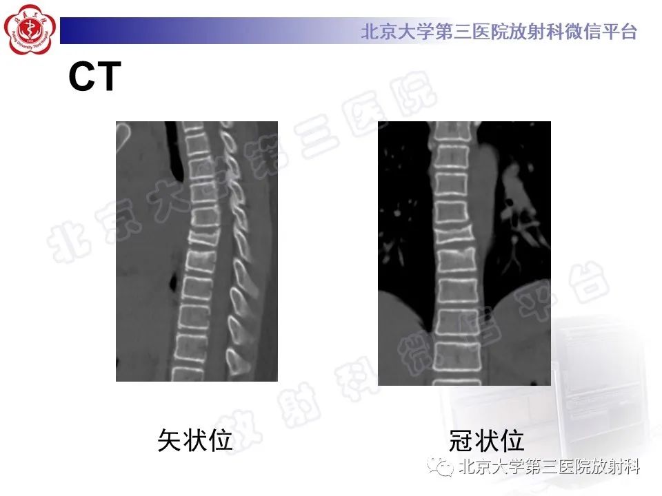 影像PPT - 【PPT】慢性复发性多灶性骨髓炎-5