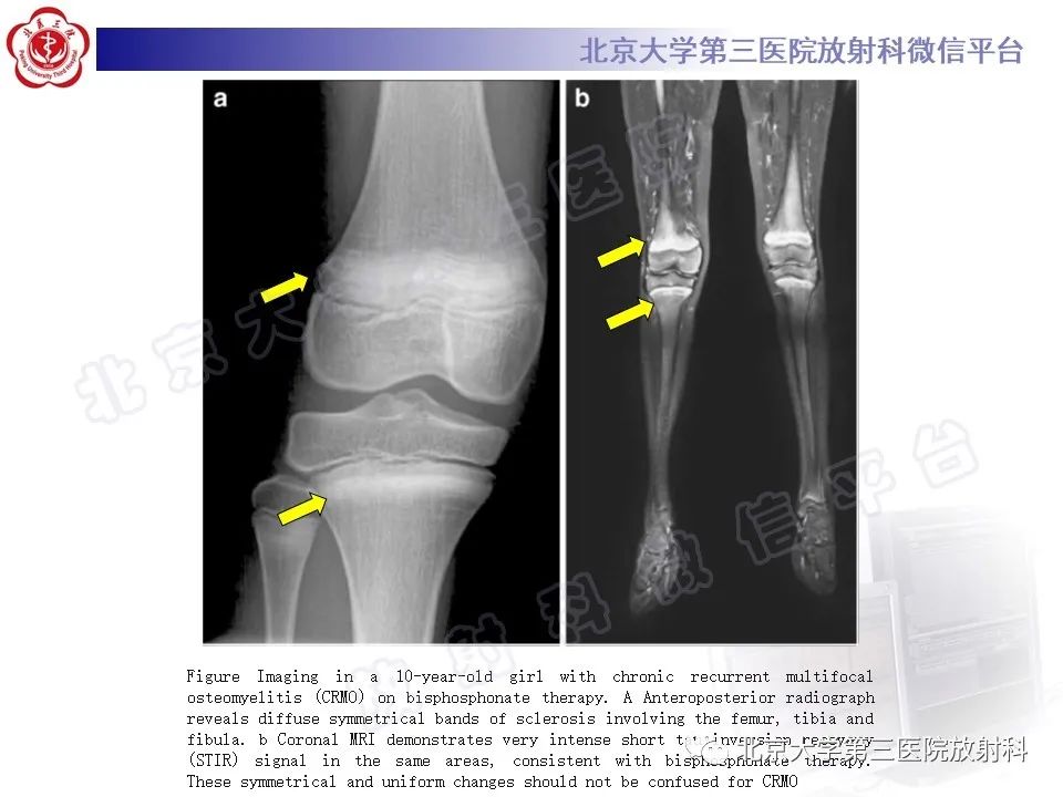 影像PPT - 【PPT】慢性复发性多灶性骨髓炎-17