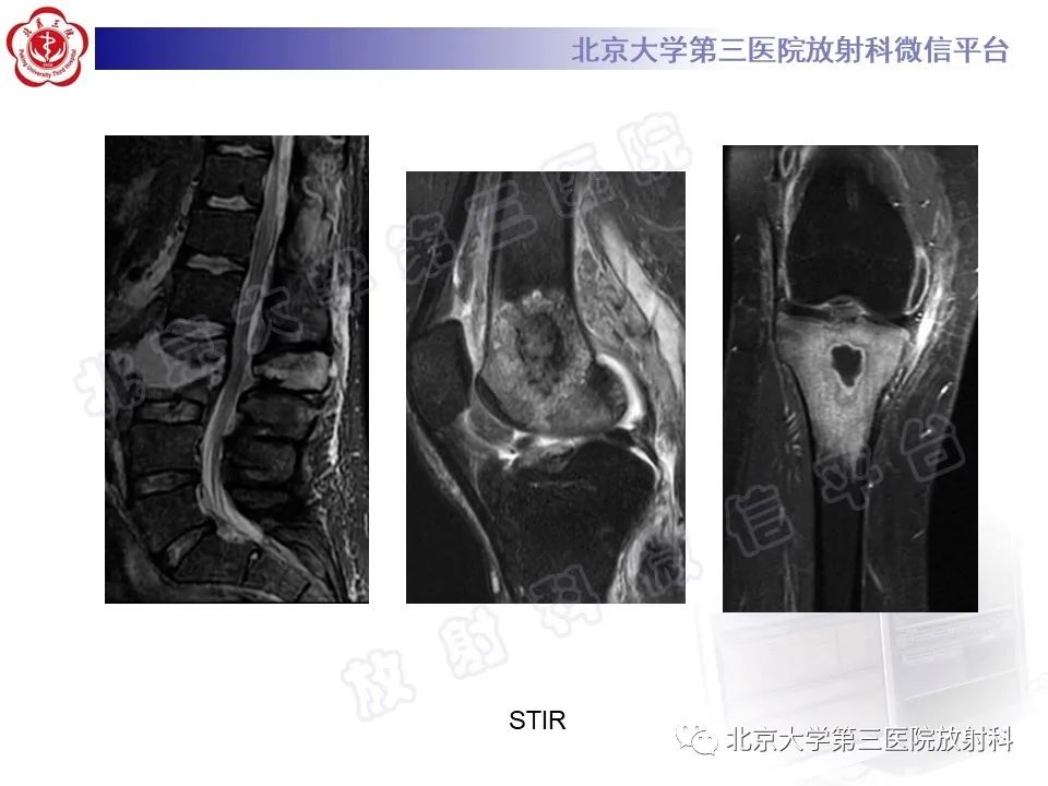 影像PPT - 【PPT】慢性复发性多灶性骨髓炎-21