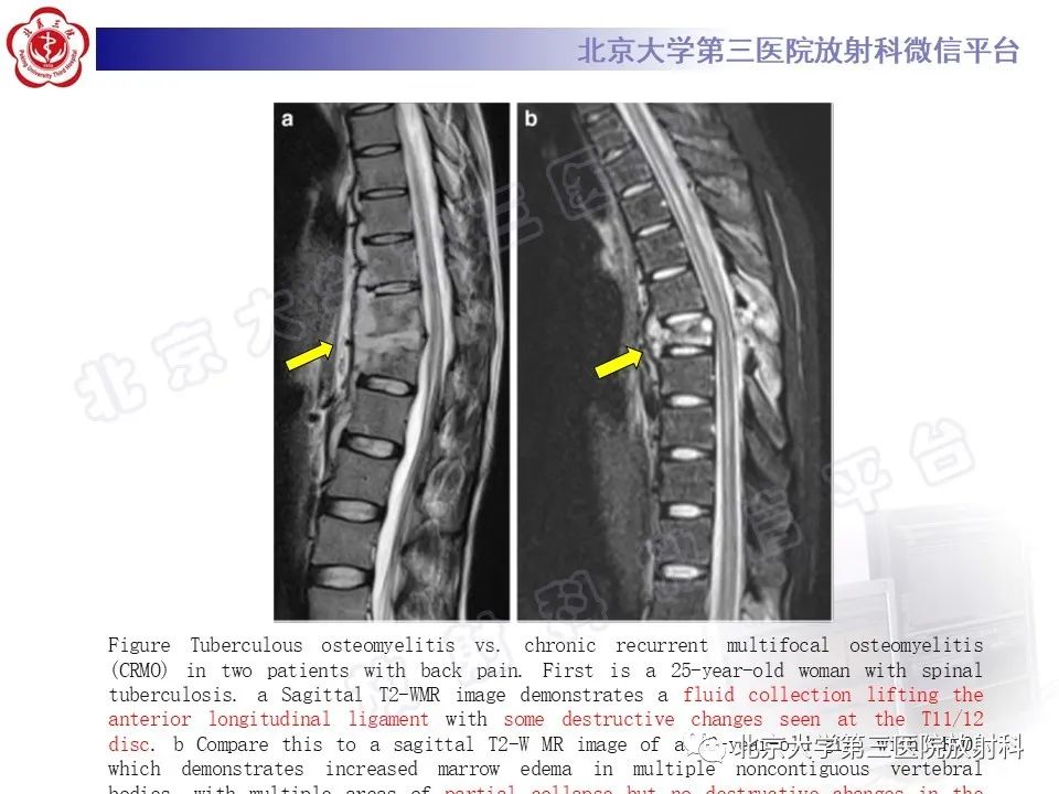 影像PPT - 【PPT】慢性复发性多灶性骨髓炎-23