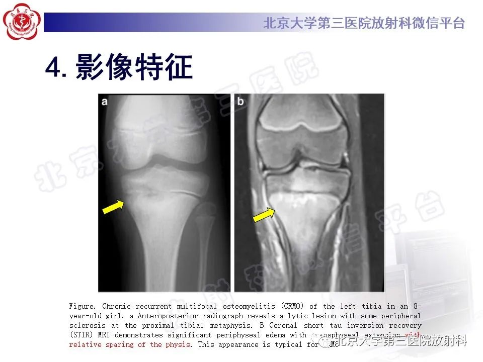 影像PPT - 【PPT】慢性复发性多灶性骨髓炎-16