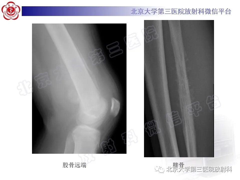 影像PPT - 【PPT】慢性复发性多灶性骨髓炎-28