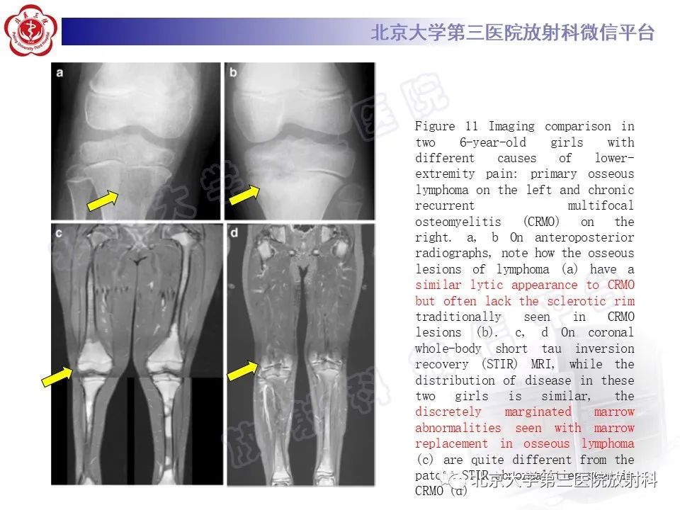 影像PPT - 【PPT】慢性复发性多灶性骨髓炎-25