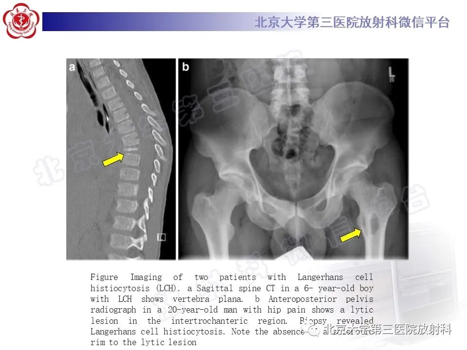 影像PPT - 【PPT】慢性复发性多灶性骨髓炎-30