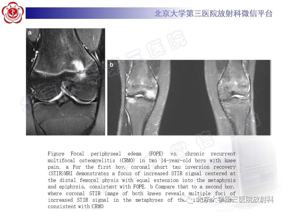影像PPT - 【PPT】慢性复发性多灶性骨髓炎-33