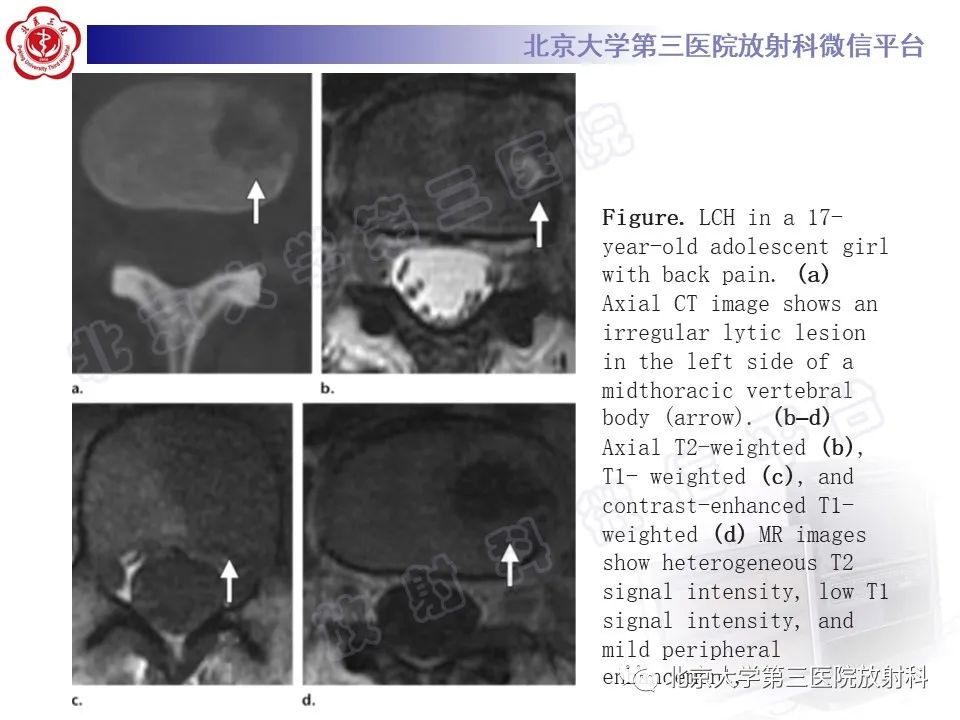 影像PPT - 【PPT】慢性复发性多灶性骨髓炎-31