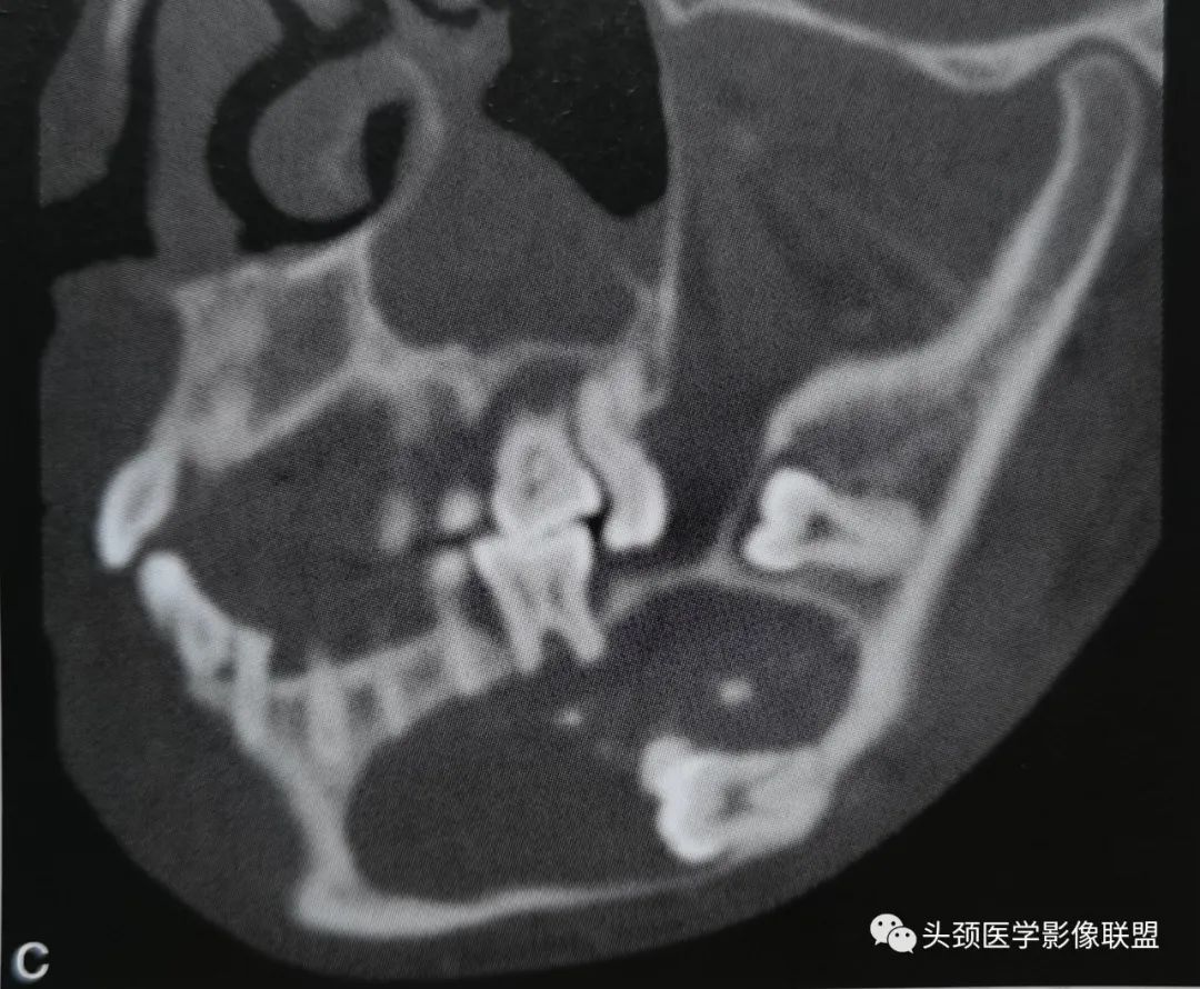 影像PPT - 牙源性钙化上皮瘤-3 影像PPT - 牙源性钙化上皮瘤-3