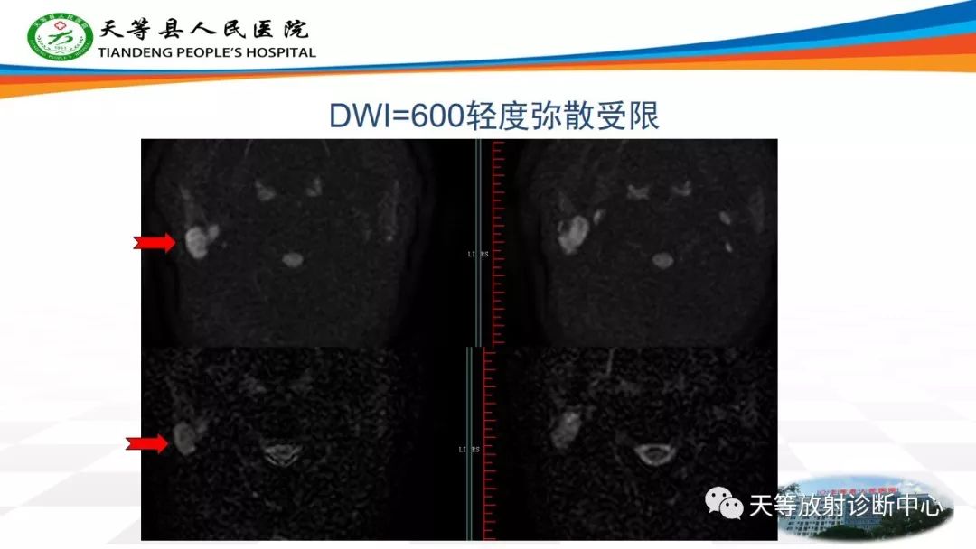 影像PPT - 【病例】腮腺腺淋巴瘤Warthin瘤1例MR影像-3 影像PPT - 【病例】腮腺腺淋巴瘤Warthin瘤1例MR影像-3