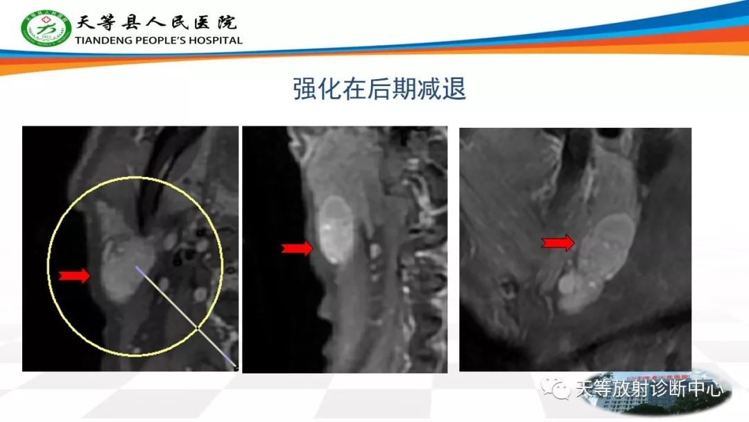 影像PPT - 【病例】腮腺腺淋巴瘤Warthin瘤1例MR影像-7 影像PPT - 【病例】腮腺腺淋巴瘤Warthin瘤1例MR影像-7