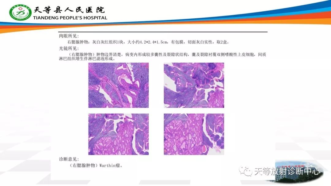 影像PPT - 【病例】腮腺腺淋巴瘤Warthin瘤1例MR影像-8 影像PPT - 【病例】腮腺腺淋巴瘤Warthin瘤1例MR影像-8