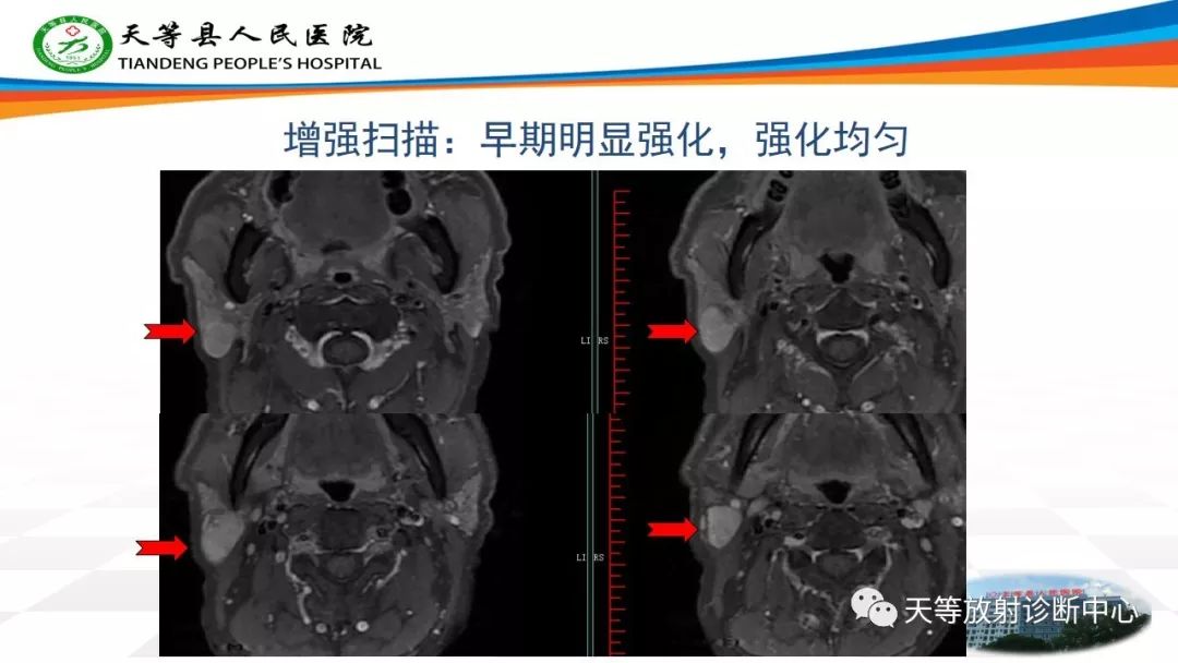 影像PPT - 【病例】腮腺腺淋巴瘤Warthin瘤1例MR影像-5 影像PPT - 【病例】腮腺腺淋巴瘤Warthin瘤1例MR影像-5