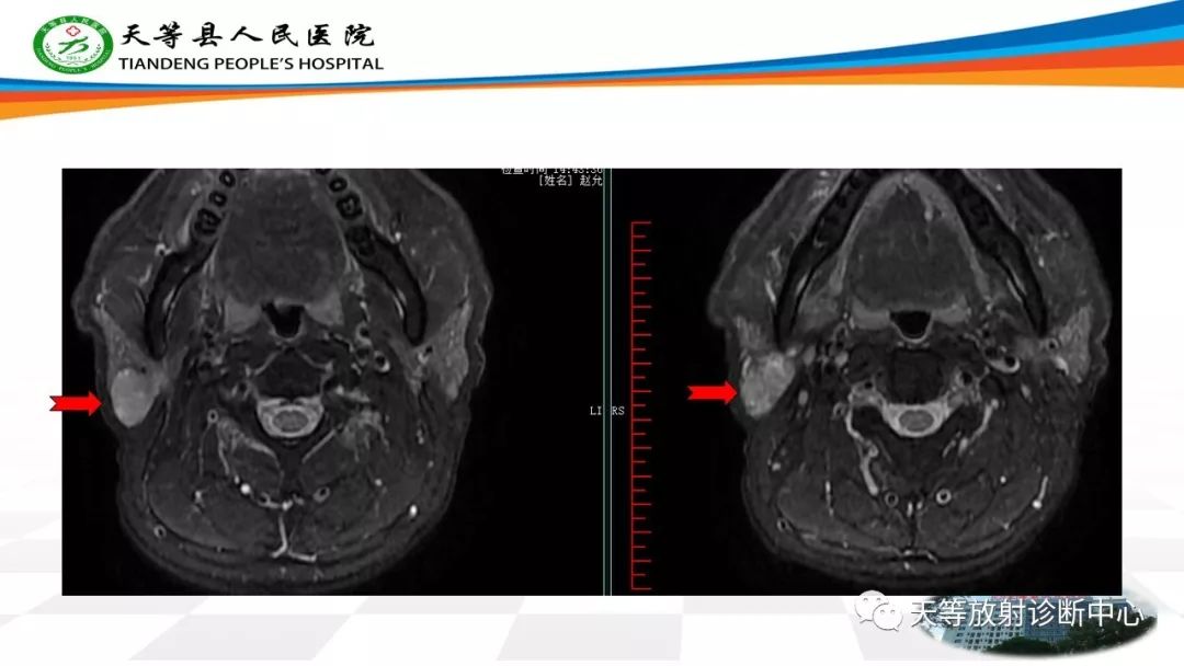 影像PPT - 【病例】腮腺腺淋巴瘤Warthin瘤1例MR影像-1 影像PPT - 【病例】腮腺腺淋巴瘤Warthin瘤1例MR影像-1