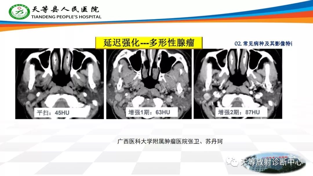 影像PPT - 【病例】腮腺腺淋巴瘤Warthin瘤1例MR影像-19 影像PPT - 【病例】腮腺腺淋巴瘤Warthin瘤1例MR影像-19