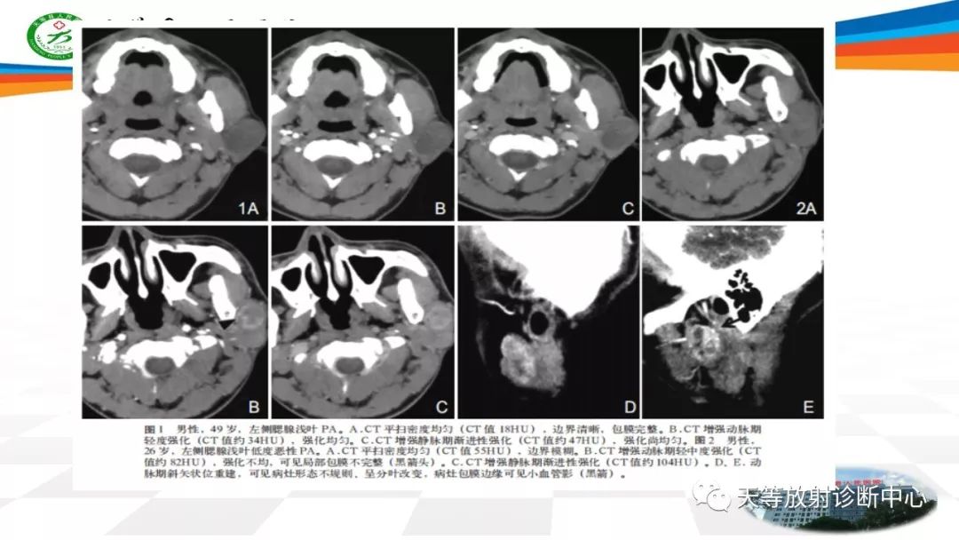影像PPT - 【病例】腮腺腺淋巴瘤Warthin瘤1例MR影像-18 影像PPT - 【病例】腮腺腺淋巴瘤Warthin瘤1例MR影像-18