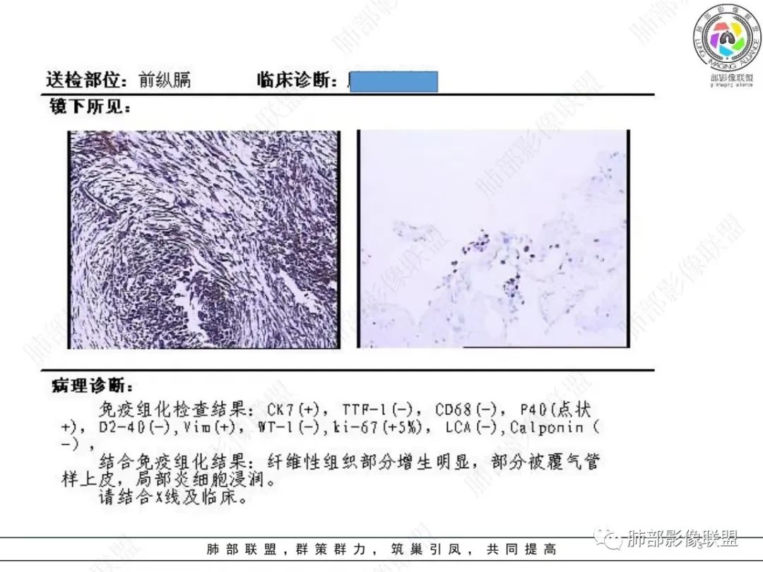 影像PPT - 【病例】肺-纵隔交界区占位病例解析-3 影像PPT - 【病例】肺-纵隔交界区占位病例解析-3
