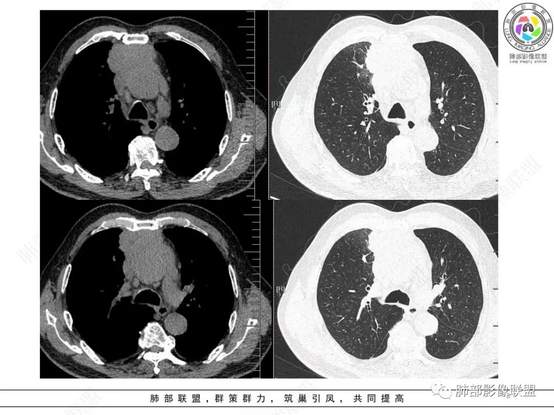 影像PPT - 【病例】肺-纵隔交界区占位病例解析-8 影像PPT - 【病例】肺-纵隔交界区占位病例解析-8