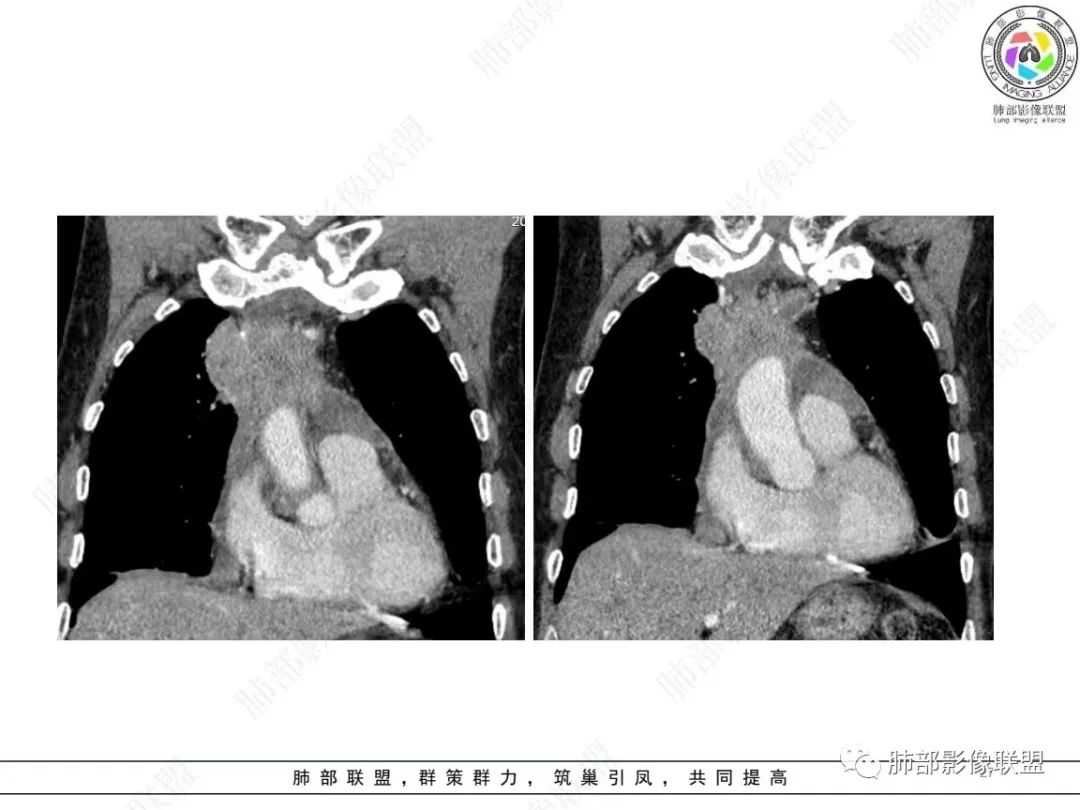 影像PPT - 【病例】肺-纵隔交界区占位病例解析-23 影像PPT - 【病例】肺-纵隔交界区占位病例解析-23