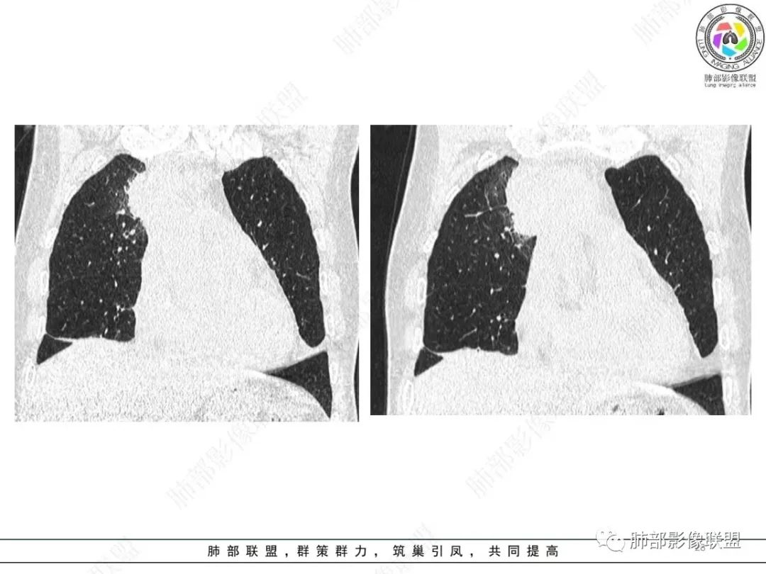 影像PPT - 【病例】肺-纵隔交界区占位病例解析-24 影像PPT - 【病例】肺-纵隔交界区占位病例解析-24
