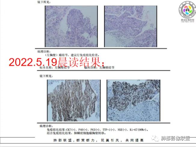 影像PPT - 【病例】肺-纵隔交界区占位病例解析-38 影像PPT - 【病例】肺-纵隔交界区占位病例解析-38