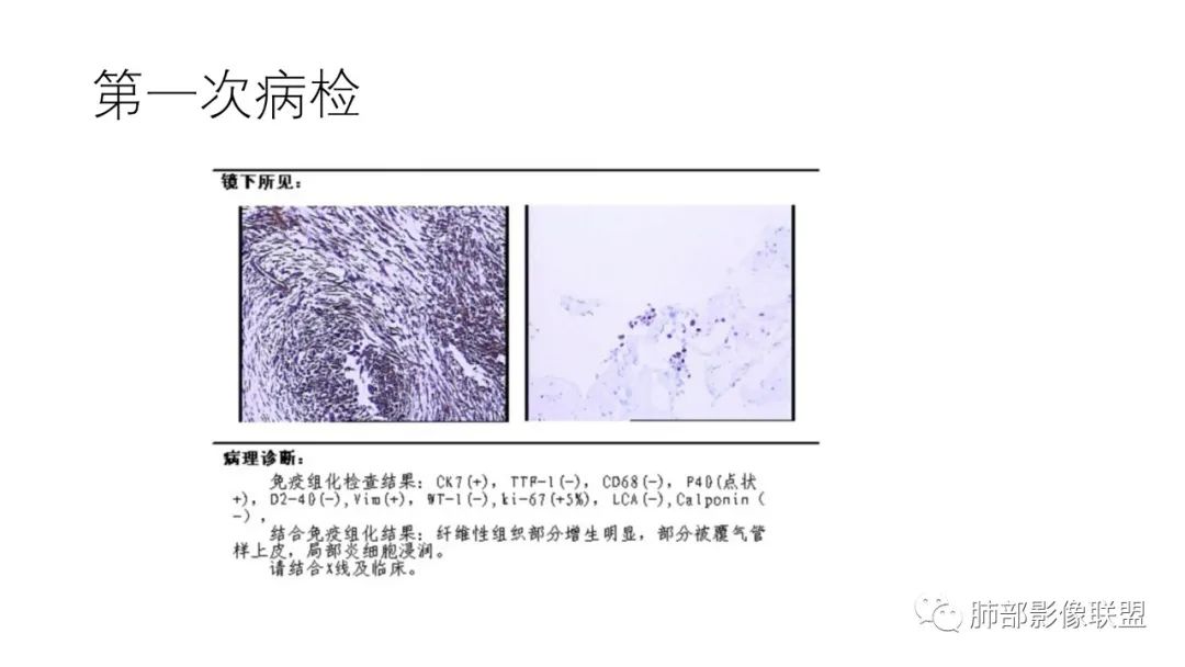 影像PPT - 【病例】肺-纵隔交界区占位病例解析-44 影像PPT - 【病例】肺-纵隔交界区占位病例解析-44