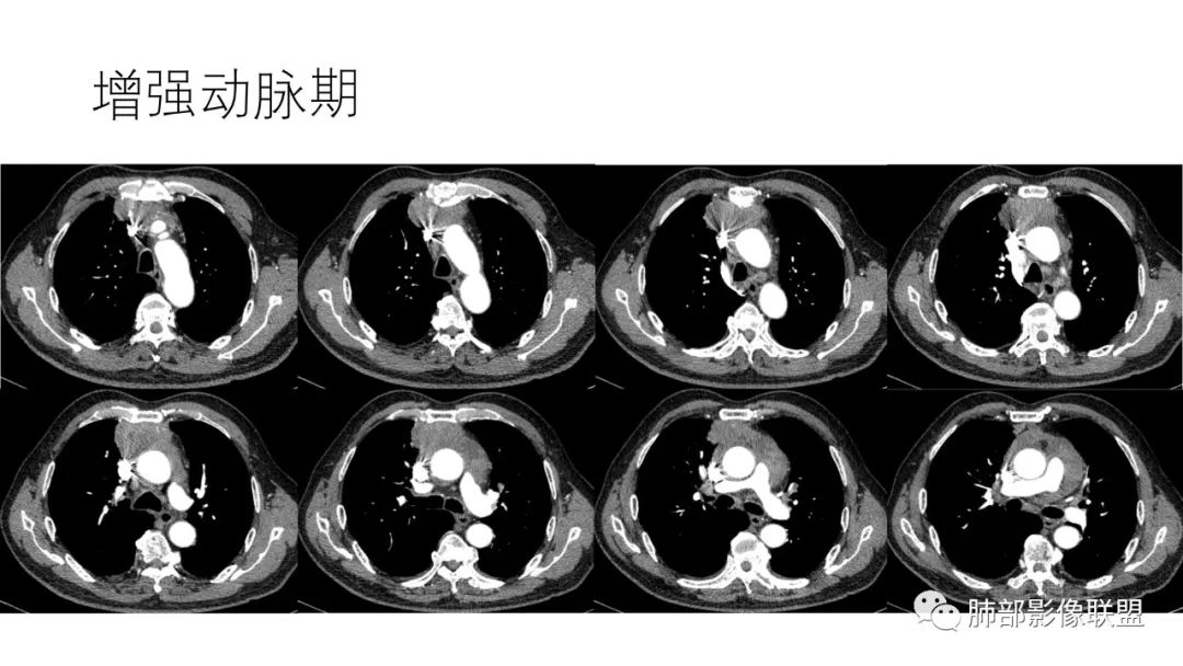 影像PPT - 【病例】肺-纵隔交界区占位病例解析-47 影像PPT - 【病例】肺-纵隔交界区占位病例解析-47
