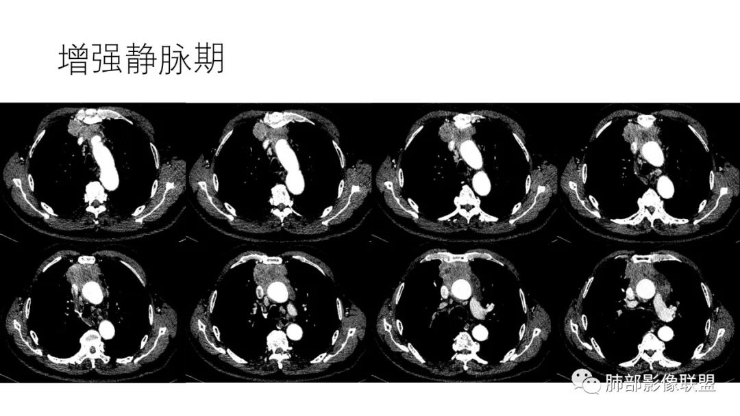 影像PPT - 【病例】肺-纵隔交界区占位病例解析-48 影像PPT - 【病例】肺-纵隔交界区占位病例解析-48