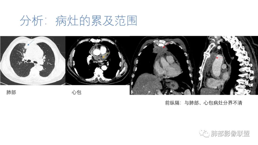 影像PPT - 【病例】肺-纵隔交界区占位病例解析-55 影像PPT - 【病例】肺-纵隔交界区占位病例解析-55