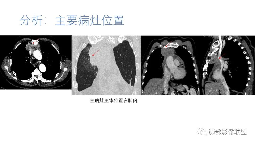 影像PPT - 【病例】肺-纵隔交界区占位病例解析-56 影像PPT - 【病例】肺-纵隔交界区占位病例解析-56