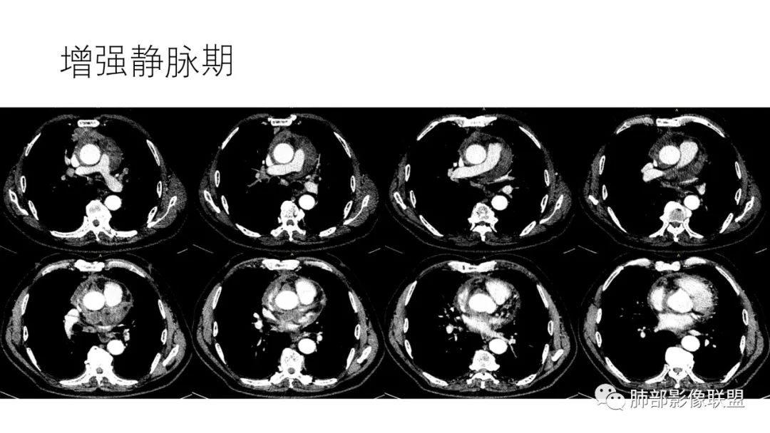 影像PPT - 【病例】肺-纵隔交界区占位病例解析-49 影像PPT - 【病例】肺-纵隔交界区占位病例解析-49