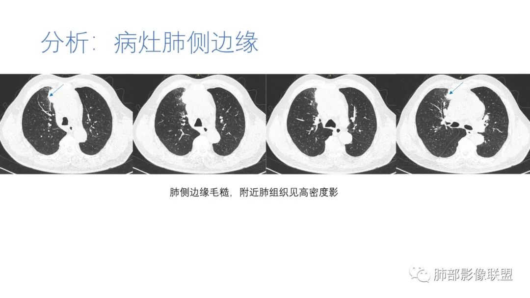 影像PPT - 【病例】肺-纵隔交界区占位病例解析-57 影像PPT - 【病例】肺-纵隔交界区占位病例解析-57