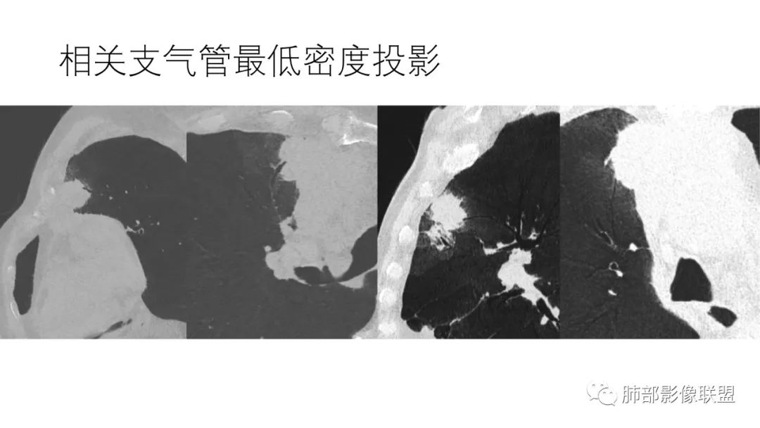 影像PPT - 【病例】肺-纵隔交界区占位病例解析-53 影像PPT - 【病例】肺-纵隔交界区占位病例解析-53