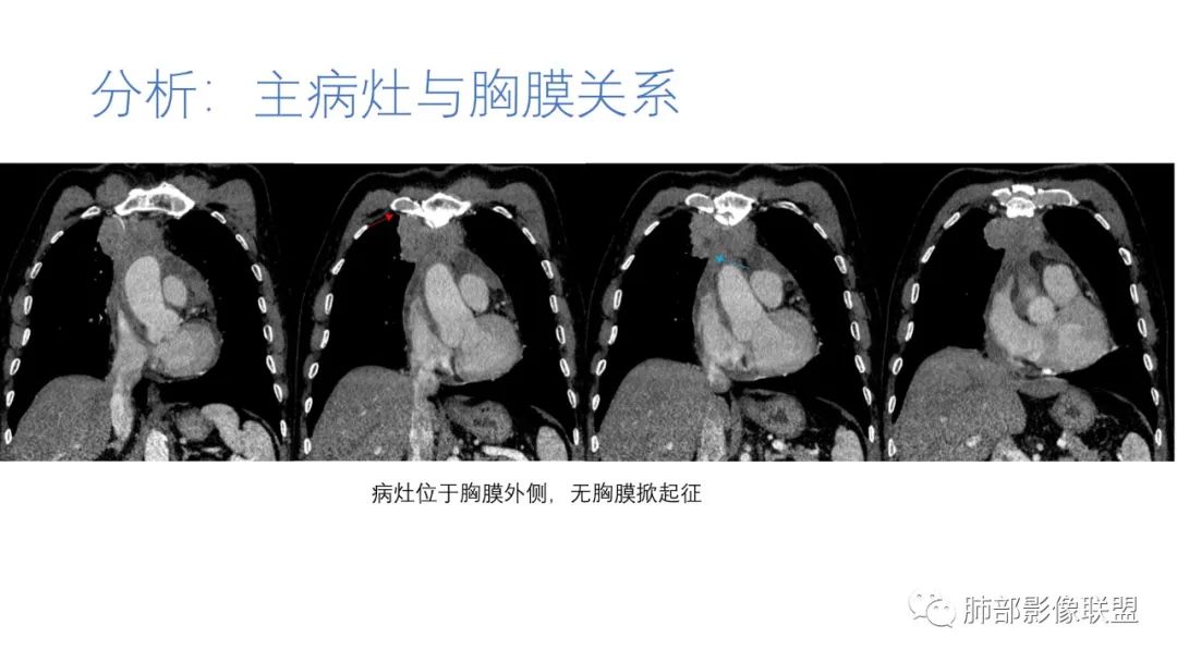 影像PPT - 【病例】肺-纵隔交界区占位病例解析-60 影像PPT - 【病例】肺-纵隔交界区占位病例解析-60