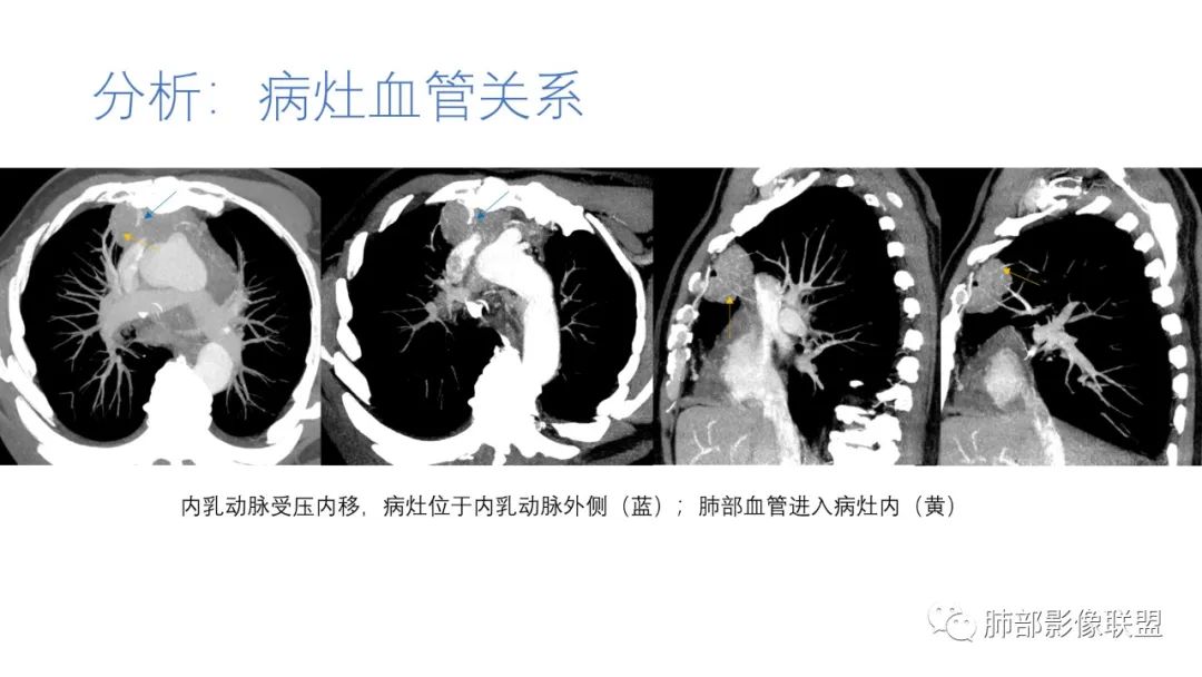 影像PPT - 【病例】肺-纵隔交界区占位病例解析-58 影像PPT - 【病例】肺-纵隔交界区占位病例解析-58