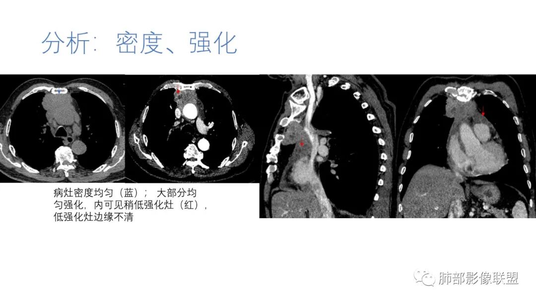 影像PPT - 【病例】肺-纵隔交界区占位病例解析-61 影像PPT - 【病例】肺-纵隔交界区占位病例解析-61