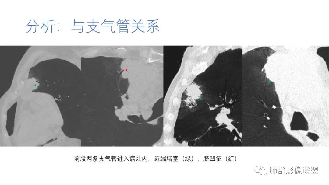 影像PPT - 【病例】肺-纵隔交界区占位病例解析-59 影像PPT - 【病例】肺-纵隔交界区占位病例解析-59