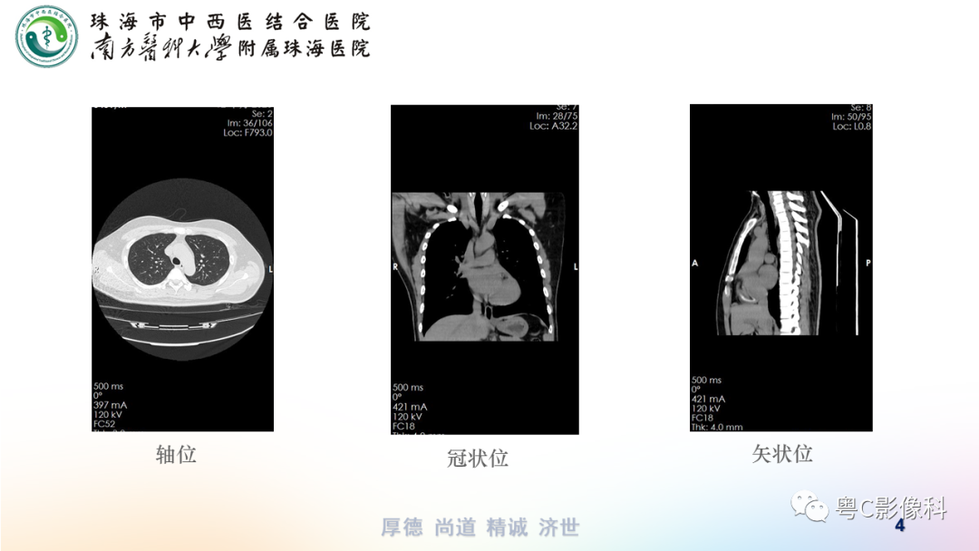 影像PPT - 【PPT】呼吸系统基本病变影像学表现-4