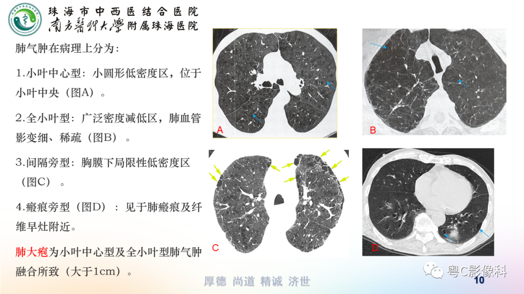 影像PPT - 【PPT】呼吸系统基本病变影像学表现-10