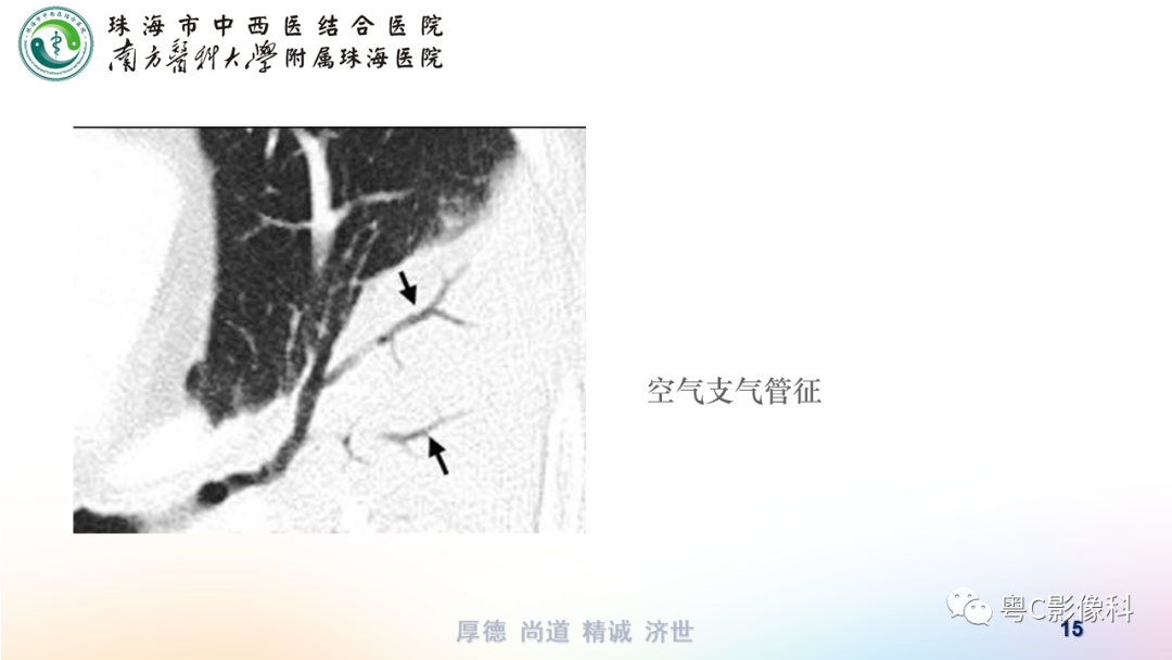 影像PPT - 【PPT】呼吸系统基本病变影像学表现-15