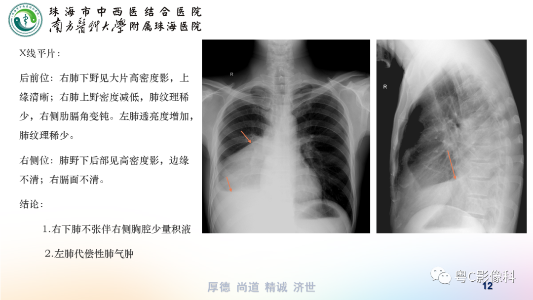 影像PPT - 【PPT】呼吸系统基本病变影像学表现-12