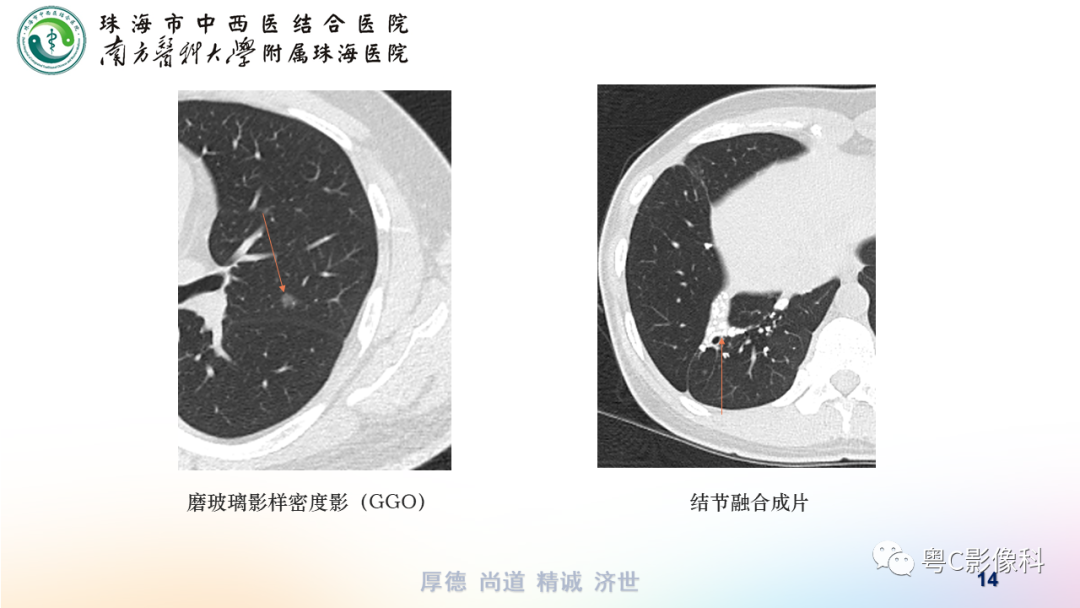 影像PPT - 【PPT】呼吸系统基本病变影像学表现-14