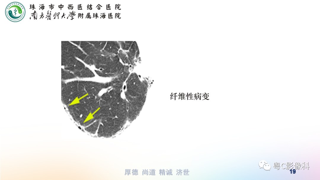 影像PPT - 【PPT】呼吸系统基本病变影像学表现-19
