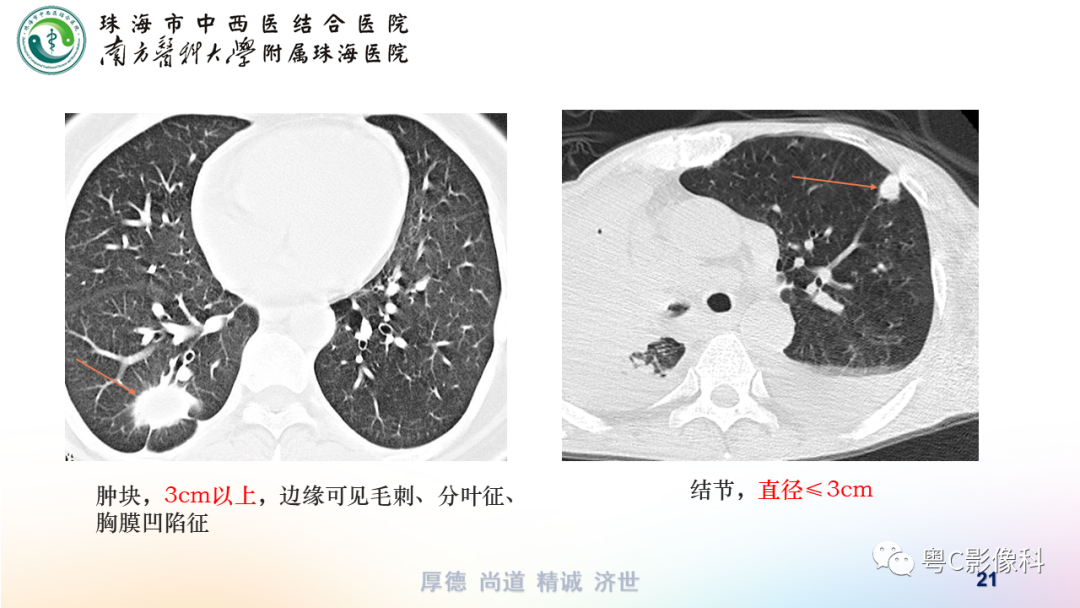 影像PPT - 【PPT】呼吸系统基本病变影像学表现-21