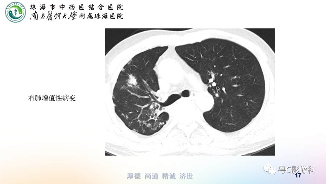 影像PPT - 【PPT】呼吸系统基本病变影像学表现-17