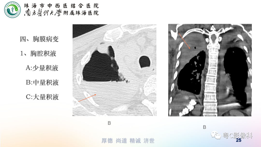 影像PPT - 【PPT】呼吸系统基本病变影像学表现-25