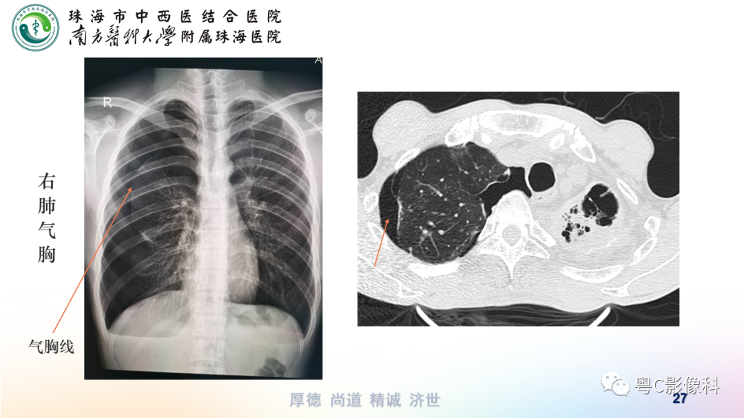 影像PPT - 【PPT】呼吸系统基本病变影像学表现-27