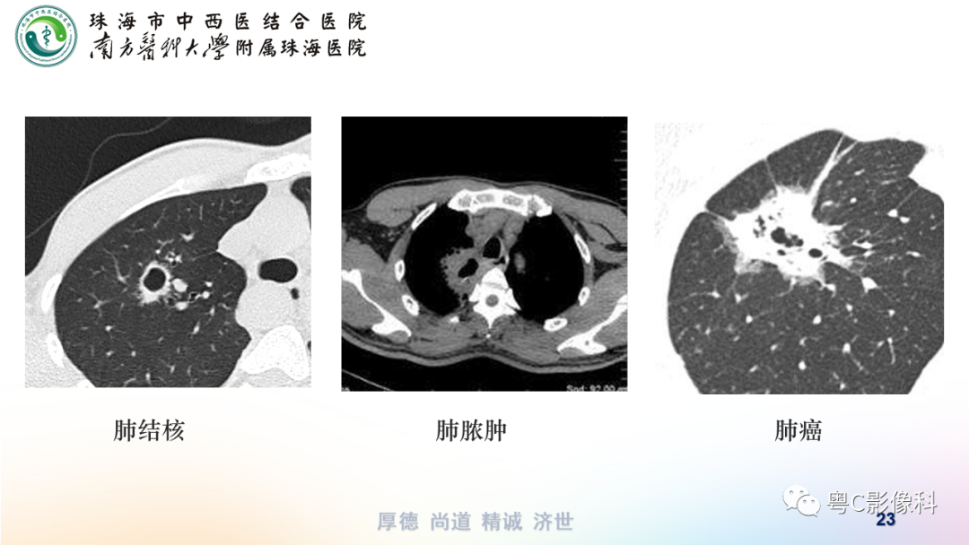 影像PPT - 【PPT】呼吸系统基本病变影像学表现-23